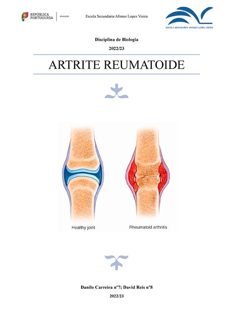 Artrite Reumatoide Escola Secundaria Afonso Lopes Vieira Disciplina