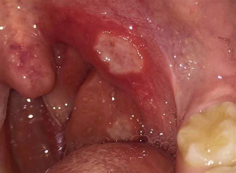 Major aphthous ulcers on the tonsil and palatoglossal arch prior to... | Download Scientific Diagram