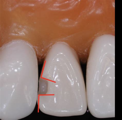 Class 3 Caries Quiz 2 Flashcards Quizlet