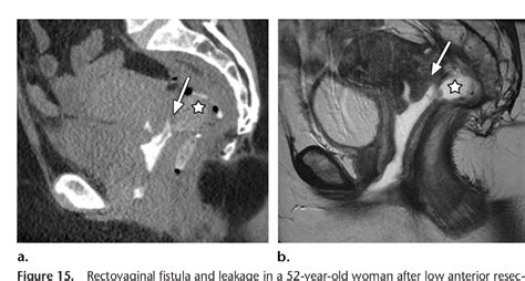 Figure 1 From Imaging And Surgical Management Of Anorectal Vaginal