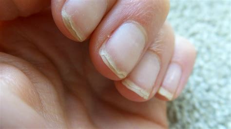 Nail Treatments For Damaged Nails Eltoria