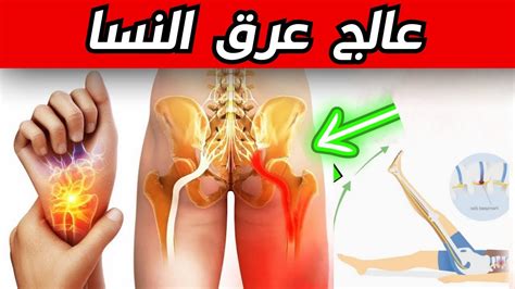 يعالج العصب الوركي ما هو عرق النسا وكيفية علاجه؟ Youtube