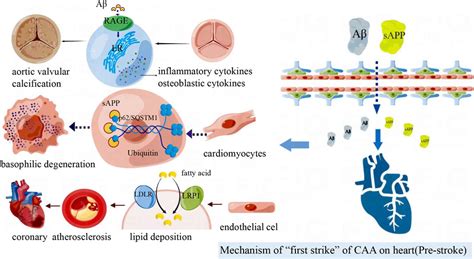 Frontiers Cerebral Amyloid Angiopathy Related Cardiac Injury Focus