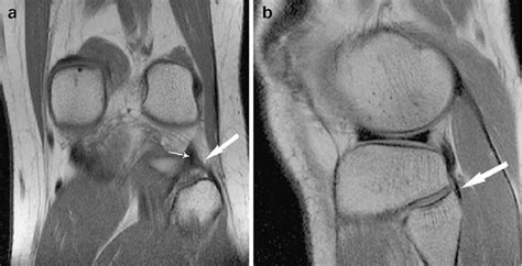 Popliteofibular Ligament Mri