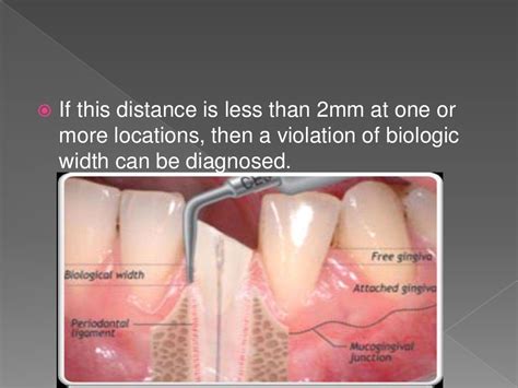 Biologic width - Importance in Periodontal and Restorative Dentistry