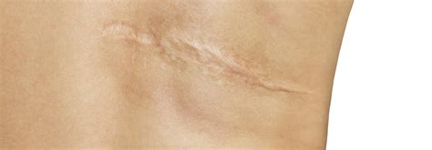 Best Scar Treatment After Surgery Uk At Claribel Seifert Blog