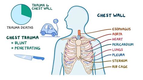 Chest Trauma Clinical Video Anatomy And Definition Osmosis