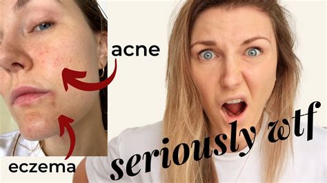 Acne And Eczema Prone Skin How Dry Combination Skin Care 3 Top Tips To Deal With Dry