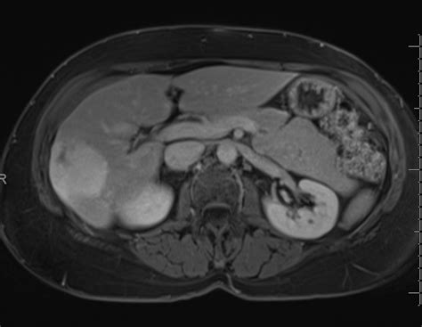 Hepatic Hemangioma Radiology Case Radshare Net