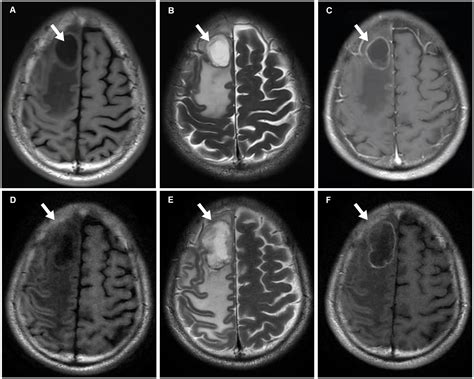 Frontiers Case Report Brain Metastasis Necrosis With Immune