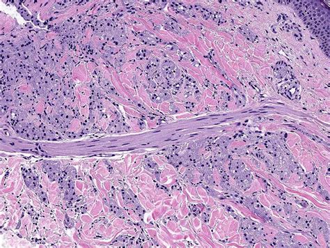 Granular Cell Tumor Histology