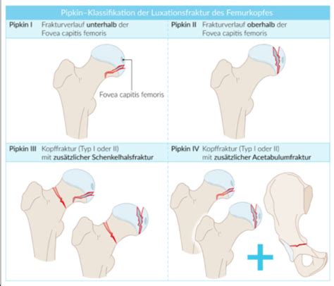 Proximale Femurfrakturen Karteikarten Quizlet