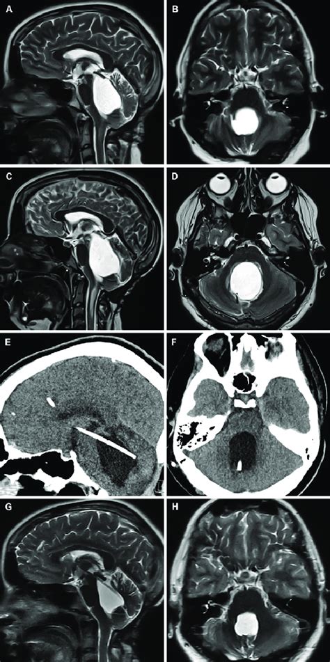 Sagittal A And Axial B T Weighted Mri Scans Months Prior To