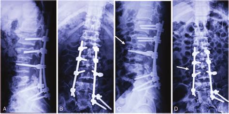 Postoperative Anteroposterior A And Lateral B Digital Radiographs Download Scientific