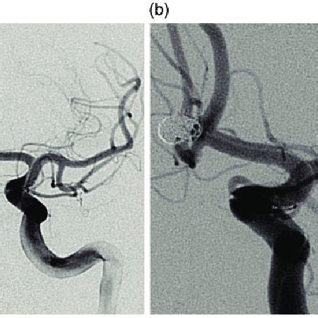 Anterior communicating artery aneurysm before (a) and after (b ...