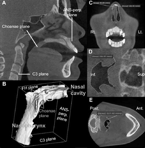 Measurements Of The Volume And Cross Sectional Area Of The Nasal Airway