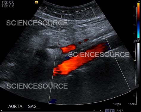 Photograph | Normal aorta, ultrasound | Science Source Images