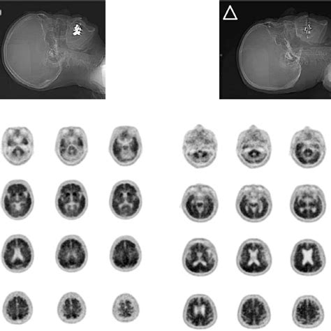 Good Circle And Poor Triangle Examples Of CT Scout And PiB PET