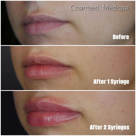 Types Of Lip Filler Injections At Charmed Medispa In Delaware Charmed Medispa