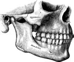 Malar Hypoplasia, with or without cleft in zygomatic bone | Rare Care World