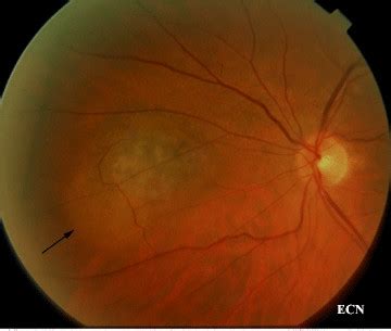 Choroidal Melanoma New York Eye Cancer Center