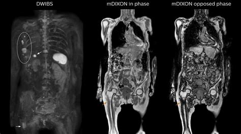 Whole Body Mri For Oncology Patients Fieldstrength Philips