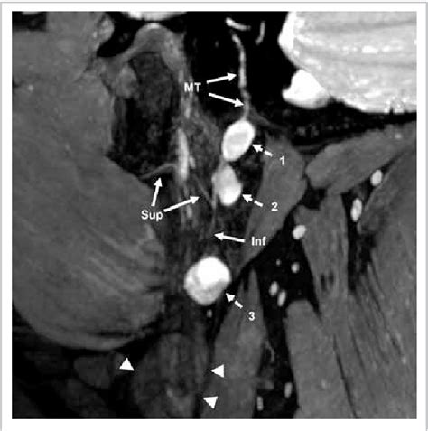 Figure From Depicting Multiple Schwannomas A Tale Of Two Magnetic