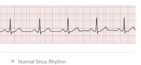 EKG Flashcards Quizlet