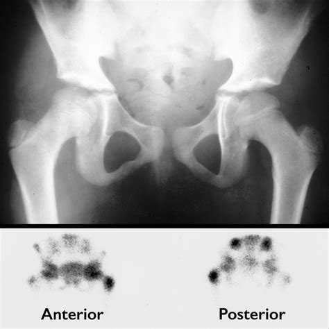 Pediatric Acute Osteomyelitis Greater Than 18 Months Pediatric