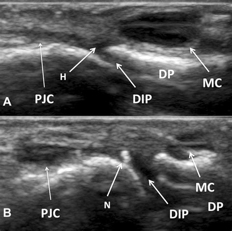 Ultrasound Images Of The Mucoid Cyst Before And After Injection A An