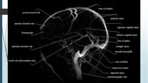 Dural Venous Sinus Thrombosis For Radiology And Imaging