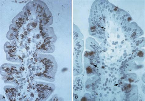 Celiac Disease Abdominal Key