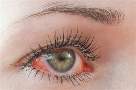 Keratitis What It Is Symptoms And Treatment Timenews