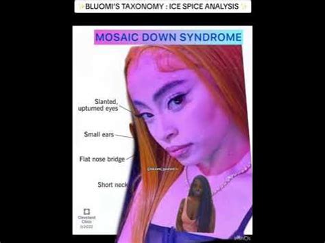 ICE SPICE & HER UNIQUE FEATURES : MOSAIC DOWN SYNDROME ? - YouTube