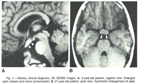 [PDF] MRI of optic chiasm and optic pathways. | Semantic Scholar