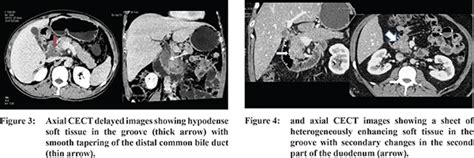 Groove pancreatitis: A series of 5 cases