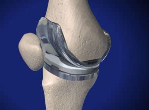 Total Knee Replacement Restoring Pain Free Mobility For Patients With