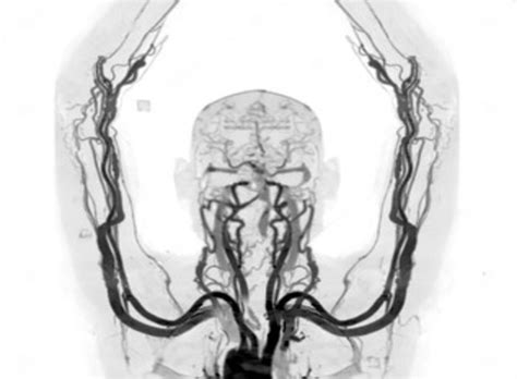 Arteriovenous Malformation Avm Treatment And Surgery In India