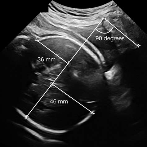 Transabdominal Sagittal Scanning Of Fetal Head The Reference Line Download Scientific Diagram