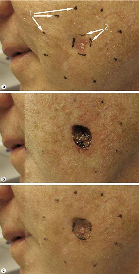 Figure 1 From Optical Coherence Tomography Used As A Modality To Delineate Basal Cell Carcinoma