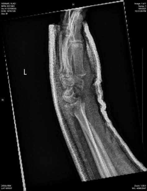 Wrist Fracture : r/xrays