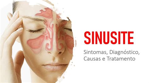 Sinusite Sintomas Diagnóstico Causas e Tratamento YouTube