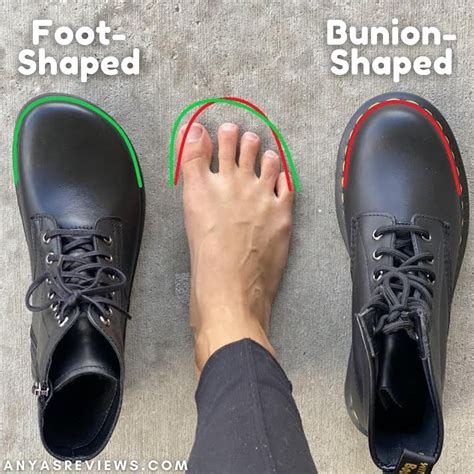 How To Help Your Bunions If You Don T Want Surgery Anya S Reviews