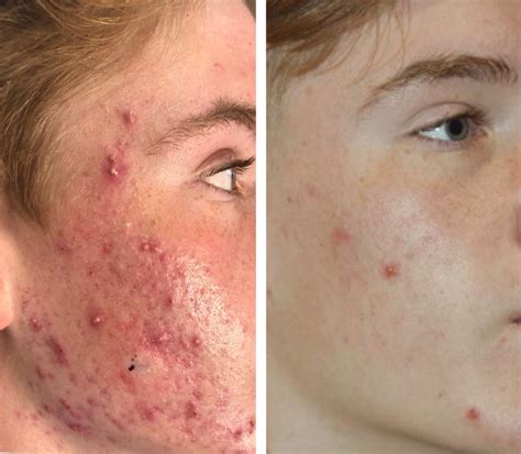 Acne Scars Treatment Near Me Springfield Il Acne Scars Treatment