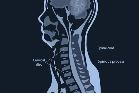 resonancia magnética de la columna cervical columna vertebral