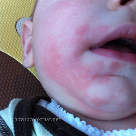 Rash Around Lips Food Allergy