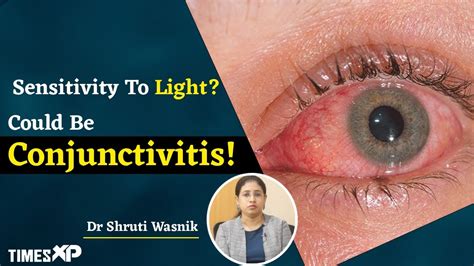 Conjunctivitis Some Tips To Prevent Conjunctivitis Explained By Doctor