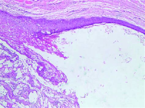 Hematoxylin And Eosin Staining The Dermoid Cyst Wall Was Surrounded By