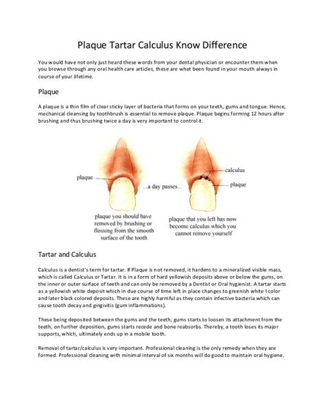 Plaque Tartar Calculus Know Difference