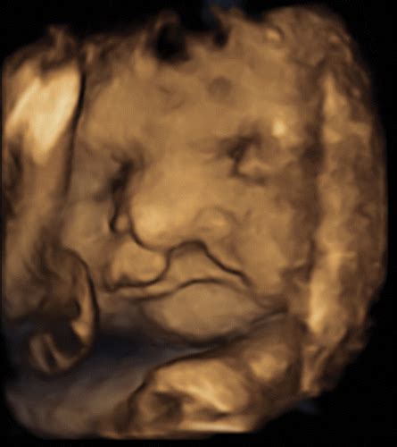 Radiology Of Cleft Lip And Palate Imaging For The Prenatal Period And